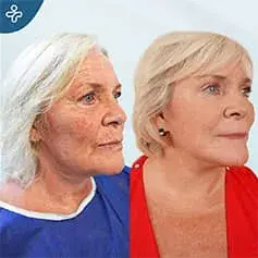 Lifting du Visage & Blépharoplastie en Turquie