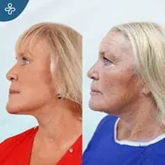 Lifting du Visage & Blépharoplastie en Turquie