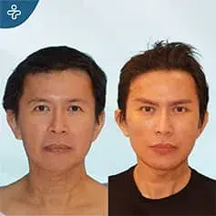 Rajeunissement complet du visage avant et après