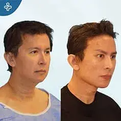 Rajeunissement complet du visage avant et après