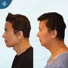 Rajeunissement complet du visage avant et après