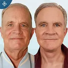 Avant et Après Rhytidectomie