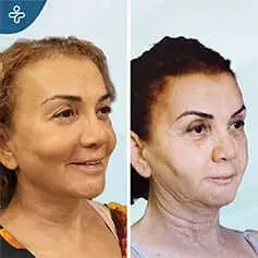 Lifting du cou après perte de poids