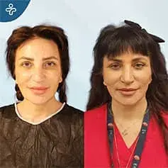 Chirurgie de lifting du cou avant et après