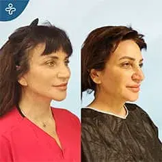 Chirurgie de lifting du cou avant et après