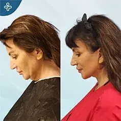Chirurgie de lifting du cou avant et après