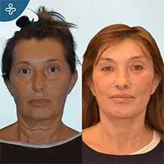 Chirurgie complète de lifting du cou avant et après