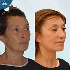 Chirurgie complète de lifting du cou avant et après