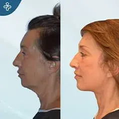 Chirurgie complète de lifting du cou avant et après