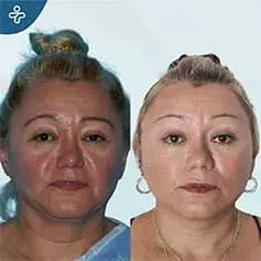 Lifting complet du cou avant et après