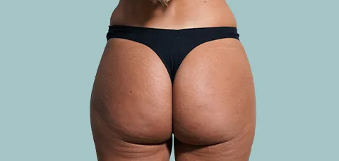 Back view of woman after Brazilian Butt Lift showing enhanced buttock shape and volume