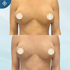 breast-lift-scars-2