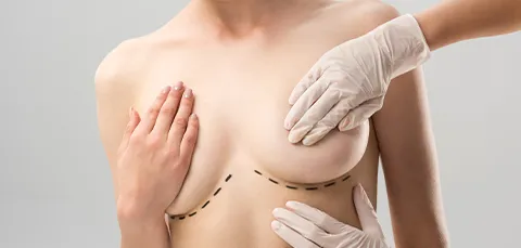 Dashed lines drawn on a womans chest to mark incision lines for breast lift surgery and potential scars