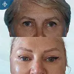 Avant et Après un Lifting des Sourcils par Botox