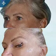 Avant et Après un Lifting des Sourcils par Botox