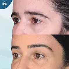 Avant et Après une Chirurgie de Lifting des Sourcils