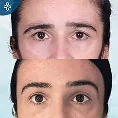 Avant et Après une Chirurgie de Lifting des Sourcils