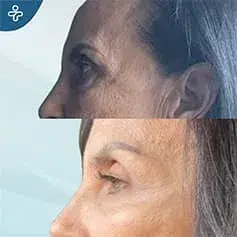 Résultats Avant et Après le Lifting des Sourcils