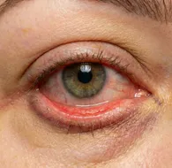 Post-OP Care