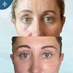 Blépharoplastie de la paupière supérieure avant et après en Turquie