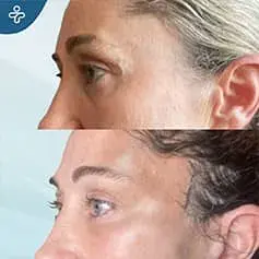 Blépharoplastie de la paupière supérieure avant et après en Turquie