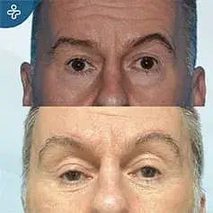 Blépharoplastie masculine supérieure avant et après