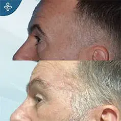 Blépharoplastie masculine supérieure avant et après