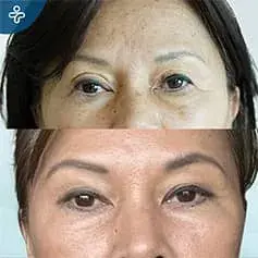 Blépharoplastie sans cicatrice en Turquie