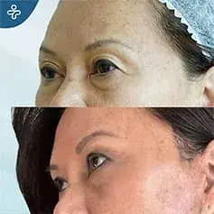 Blépharoplastie sans cicatrice en Turquie