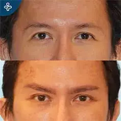 Rajeunissement du regard avant et après