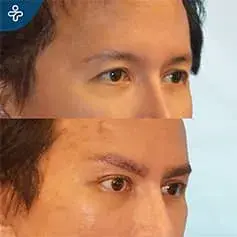 Rajeunissement du regard avant et après