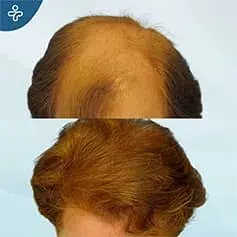 Greffe de Cheveux FUE pour Femmes en Turquie Avant et Après