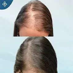 Greffe de Cheveux DHI pour Femmes en Turquie Avant et Après