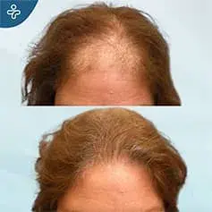 Avant et Après Greffe de la Ligne de Cheveux pour Femmes