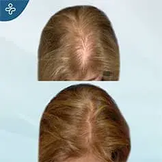 Mini Greffe de Cheveux