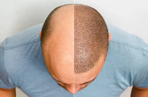 hair transplant before after