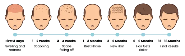 Illustrated timeline showing hair transplant recovery stages and hair growth progression