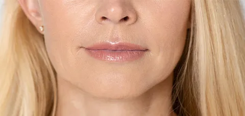 Close-up of a middle-aged woman showing signs of lip ptosis before corrective treatment in Turkey