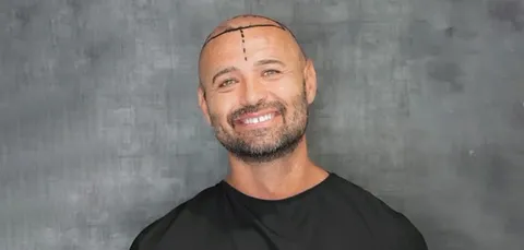 Smiling male patient with pre-op markings on scalp before hair transplant surgery