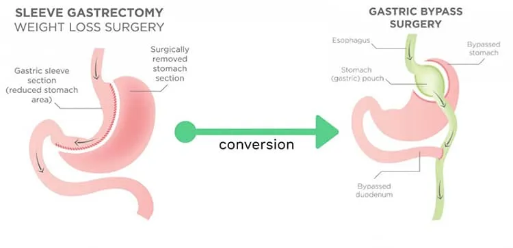 sleeve-vs-bypass