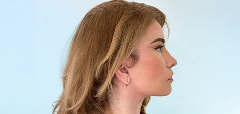 Side profile of woman showing improved jawline and cheek contour after SMAS facelift in Turkey.