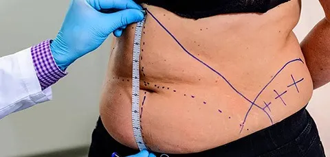 Surgeon measuring abdomen with surgical markings during tummy tuck consultation for abdominoplasty eligibility