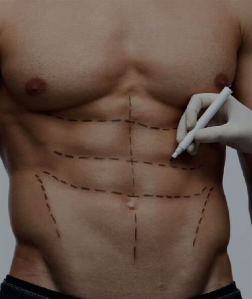 Liposuction in Turkey (Cost & Reviews) Care in Turkey
