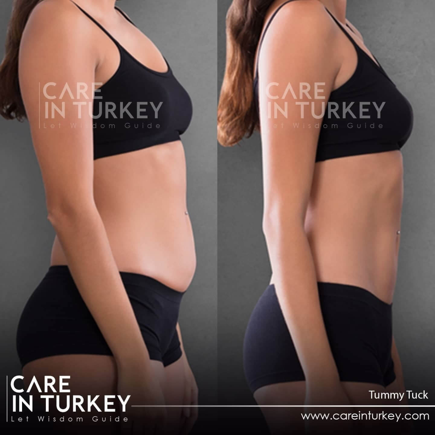 Hourglass Tummy Tuck Surgery & Recovery