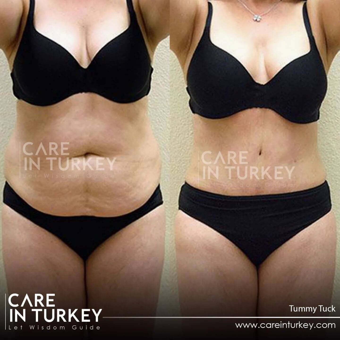 Before & After Fleur-de-Lis Tummy Tuck