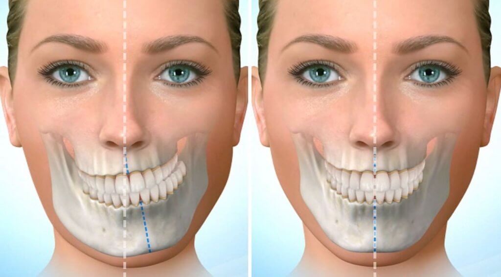 two jaw surgery, 3D design face guide for two jaw surgery, The Face Dental  Clinic