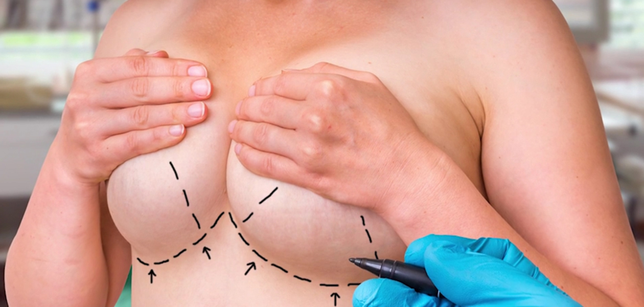 Surgical Resection False Breast After Breast Surgery Artificial