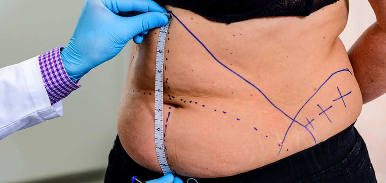 Can You Get a Tummy Tuck on the NHS?