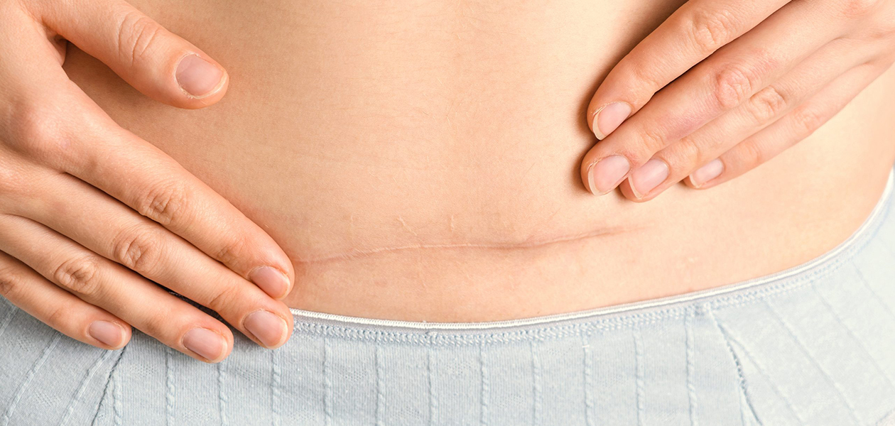 Avoid the Risks: Understanding Tummy Tuck Failures